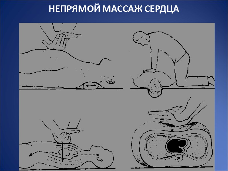 НЕПРЯМОЙ МАССАЖ СЕРДЦА